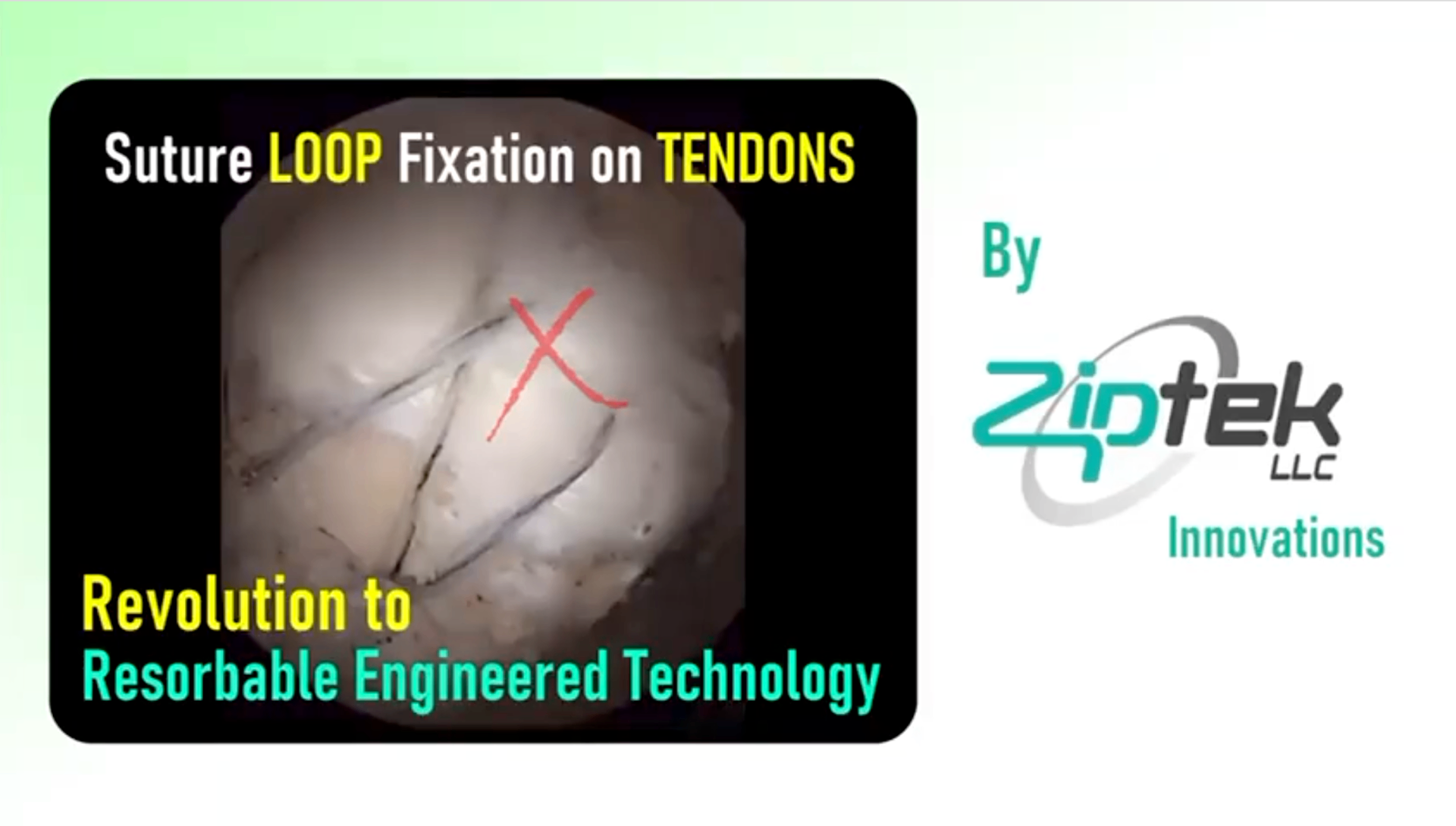 Ziptek ZipTek Global - Surgical Repair Technology | Resorbable Locking Systems
