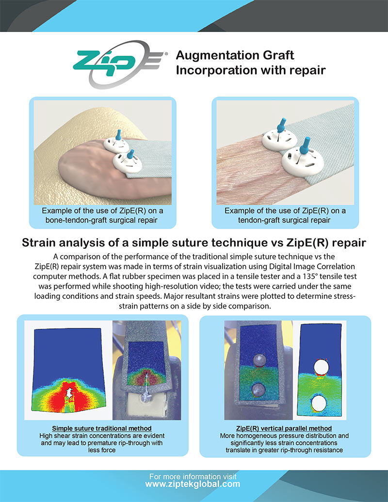 ZipE® Augmentation Graft Fixation and Dynamic Image Capture Comparison