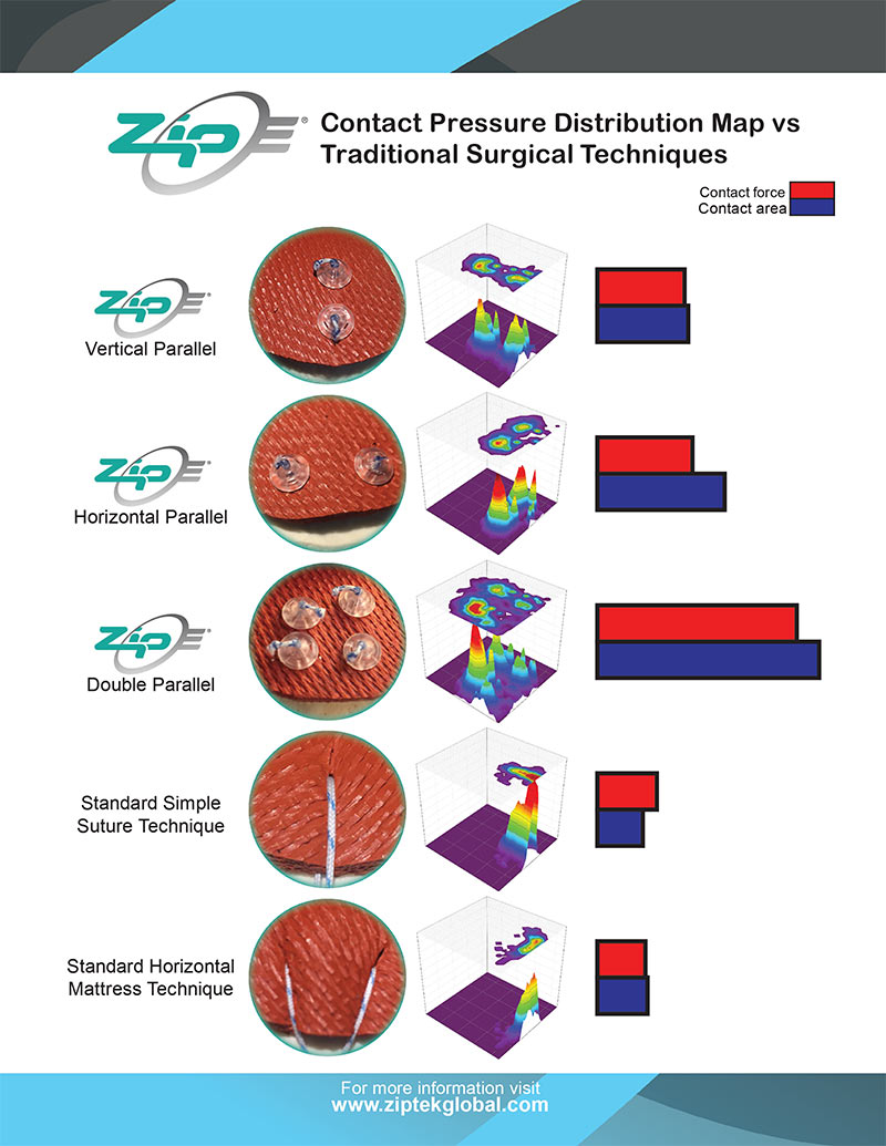 ZipE® Contact Pressure and Area Comparisons