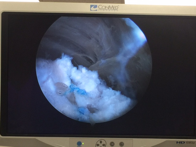 Low Profile ZipE absorbable captures shown in double parallel configuration in rotator cuff repair.