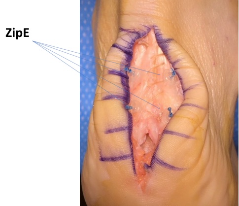 Achilles Tendonitis-Haglund Repair