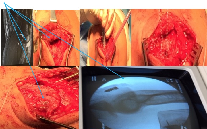 Distal Triceps Repair