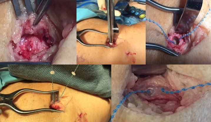 Medial Collateral Ligament Repair