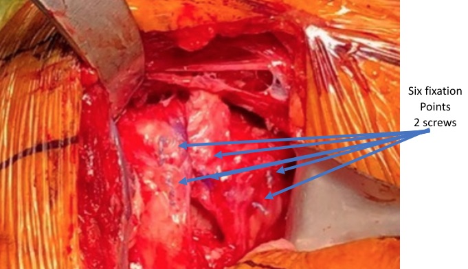 Shoulder Replacement-subscapularis Closure